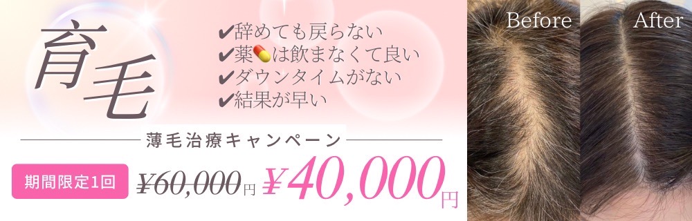 薄毛治療キャンペーン 60,000円が40,000円