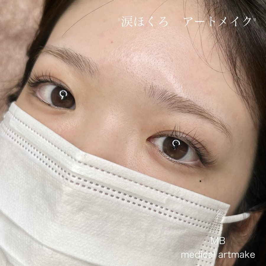 涙ほくろアートメイクの仕上がり